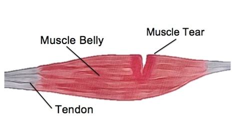 test dr can do in office for muscle tear|muscle tear mri scan.